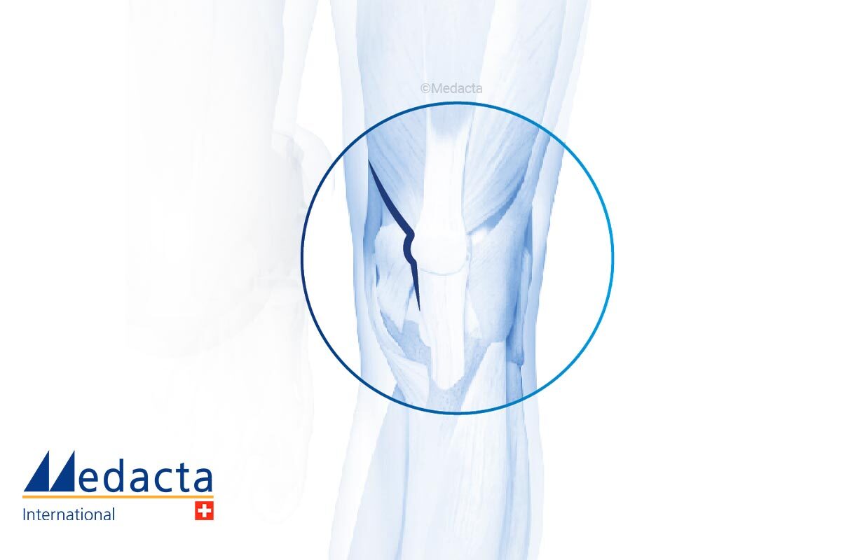 Subvastus